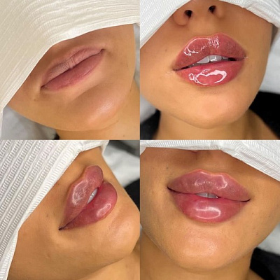 Lip contouring REPART® Supreme Soft | UltraSave