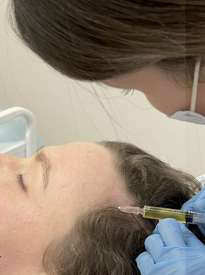 PRP-therapy for the scalp | UltraSave