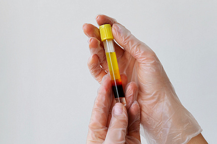 PRP Therapy for the Intimate Area | UltraSave
